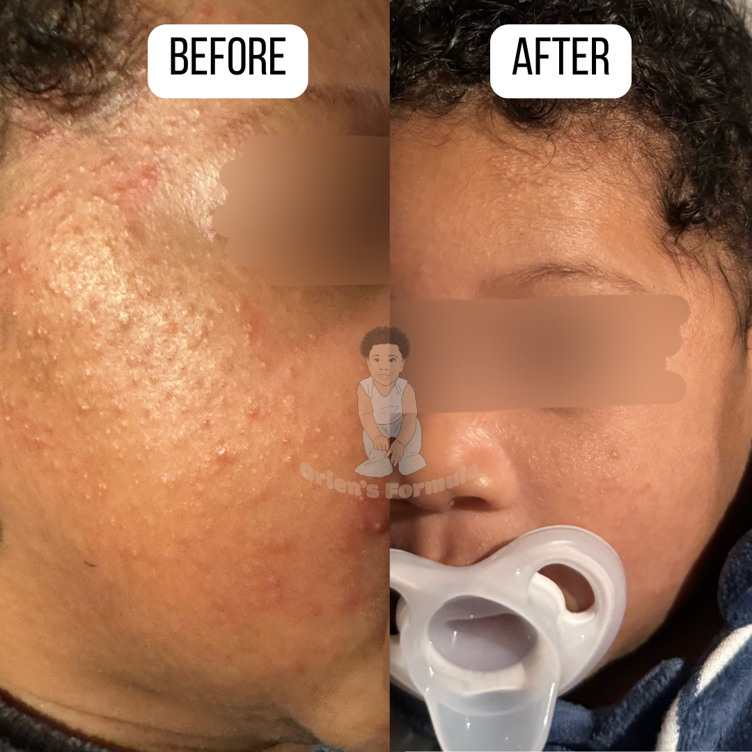 Orien's Mama Method: A Real Baby’s Skin Transformation